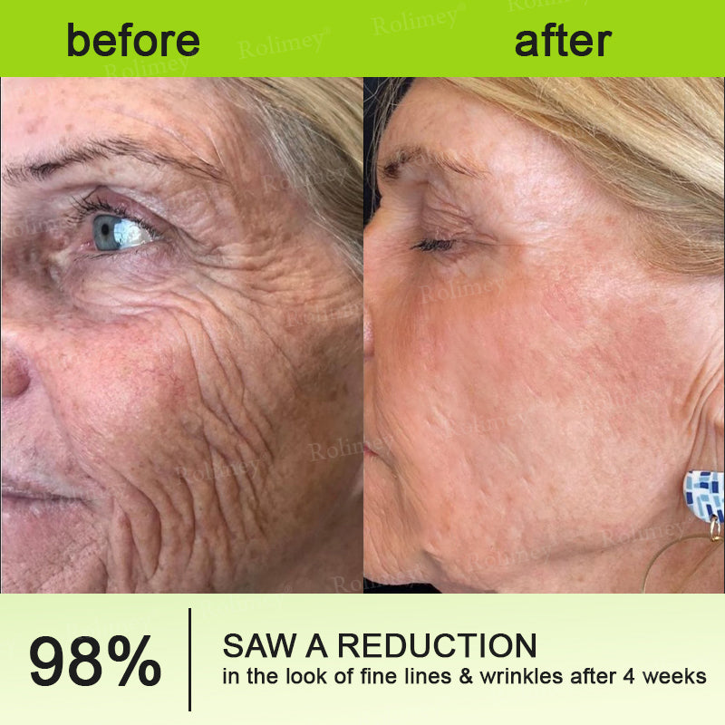 ✨👨‍⚕️Made and shipped from the UK 💫Rolimey® Botox & Vita-A Retinol Shot Wrinkle-Lift Tightening cream - Last Day Promotion 70% OFF