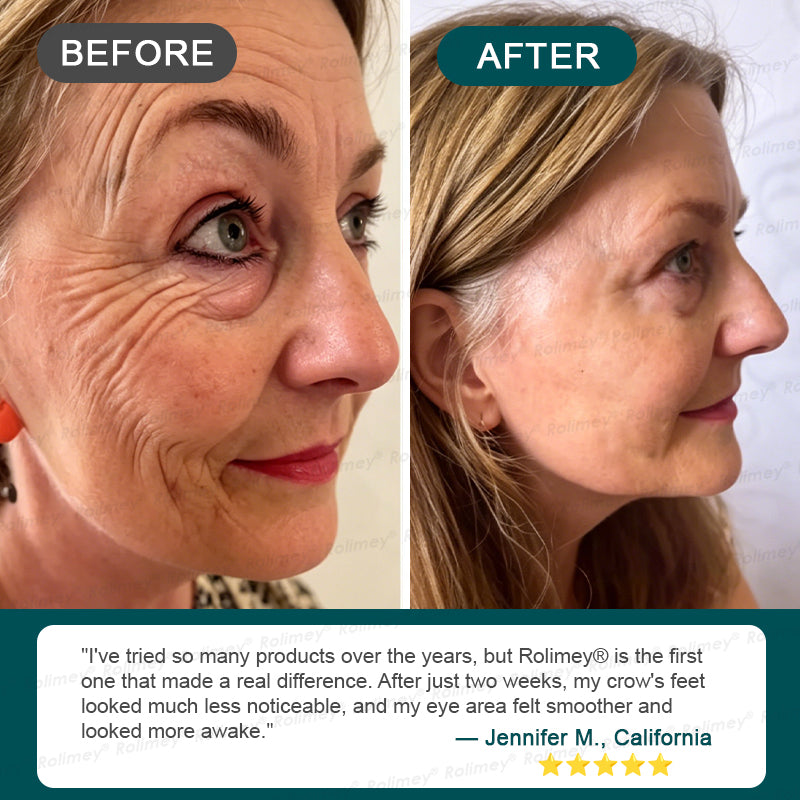 Rolimey® Botox & Stem Cell Wrinkle-Lift Tightening Cream