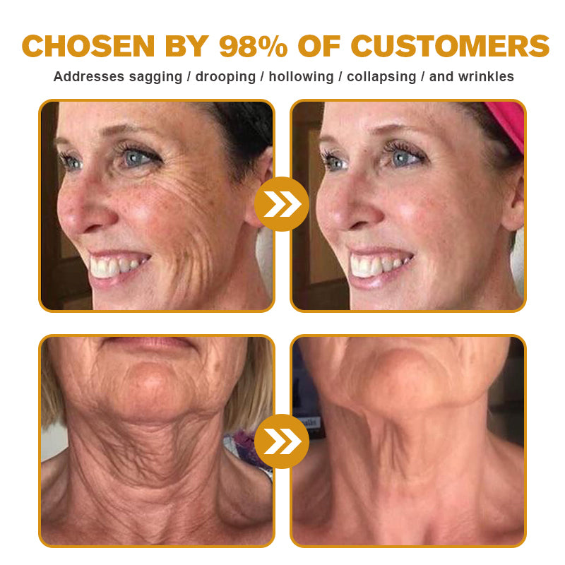 ✨🍀Made and shipped from the UK ✅Flysmus® Botox Bee Venom Wrinkle Removal Cream-Last Day Promotion 70% OFF