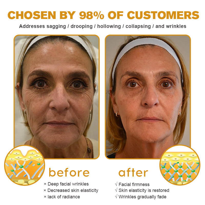 ✨🍀Made and shipped from the UK ✅Flysmus® Botox Bee Venom Wrinkle Removal Cream-Last Day Promotion 70% OFF